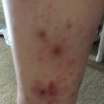 ravagé par la punaise de lit lyonnaise